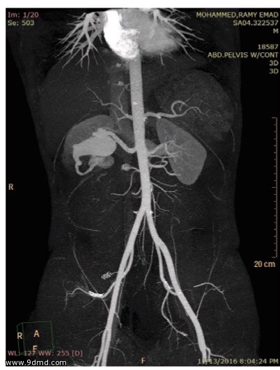 تمدد في الشريان الكلوي الايمن داخل الكلي "حاله نادرة"